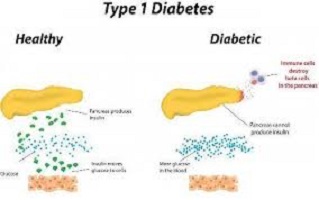 Type 1 diabetes treatment